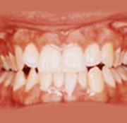 عادتهایی که دندان‌ها را خراب می‌کنند dan1 180x174