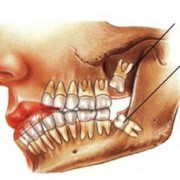 آشنایی با عوارض دندان عقل hhh674 180x180