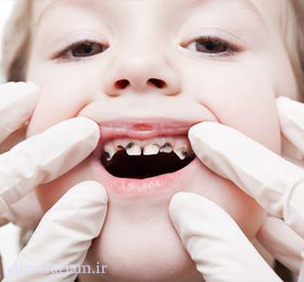 posidgi posidgi پوسیدگی دندان جلوگیری از پوسیدگی دندان ها با این روش ها posidgi