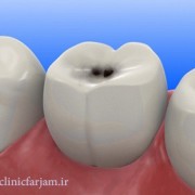 عوامل تخریب دندان ها  عواملی که باعث تخریب دندان ها می شود takhrib 180x180