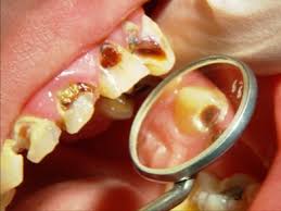 nhnhh nhnhh پوسیدگی دندان آیا زود پوسیده شدن دندانها مربوط به جنس آنهاست؟ nhnhh