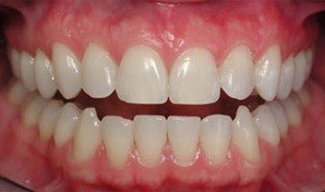 lase lase بیماری های لثه نکاتی جهت جلوگیری از بروز بیماری های لثه lase