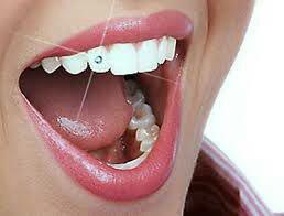 photo_2016-08-29_12-35-00 photo_2016-08-29_12-35-00 نگین های دندانی آنچه در مورد چسباندن نگین بر روی دندان باید دانست. photo 2016 08 29 12 35 00