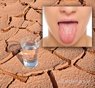 khoshki-dahan khoshki-dahan خشکی دهان و درمان آن دلایل و درمان خشکی دهان khoshki dahan