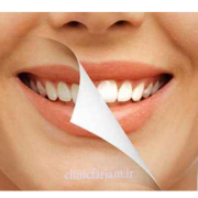 نکاتی در مورد جرمگیری  نکاتی درمورد جرمگیری jermgiri 180x180