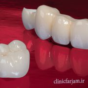 بهترین نوع روکش دندان  بهترین نوع روکش دندان کدام است ؟ rokesh 180x180