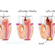 آبسه چیست؟  آبسه چیست؟ abse 180x180