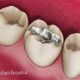 پر کردن دندان با آمالگام  چرا دهان مزه فلز می‌گیرد؟! amalgam 80x80