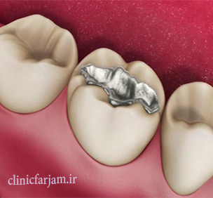 amalgam amalgam پر کردن دندان با آمالگام پر کردن دندان با آمالگام amalgam
