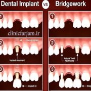 مزیت‌های ایمپلنت نسبت به بریج  مزیت‌های ایمپلنت نسبت به بریج brigeimplant 180x180