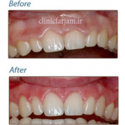 اصلاح بیرون بودن بیش از حد لثه در لبخند  اصلاح بیرون بودن بیش از حد لثه در لبخند 123 180x180
