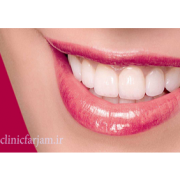 لبخندی زیبا و بدون نقص  روشهایی جهت بدست آوردن لبخندی زیبا و بدون نقص labkhand 180x180