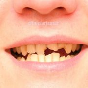 شکستگی دندان  با دندان شکسته کودک چه کنیم ؟ dandan shekaste 180x180