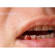 خونریزی لثه  چرا موقع مسواک زدن ، لثه هایتان خونریزی می کند؟ lase khonrizi 180x180