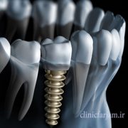 کاشت ایمپلنت بعداز کشیدن دندان  کاشت ایمپلنت بعداز کشیدن دندان implant12 180x180
